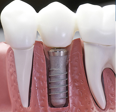 precision dental dental implants