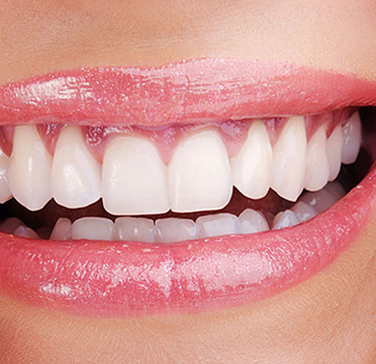 precision dental Teeth Whitening