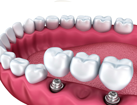 dental-implant-bridge-web