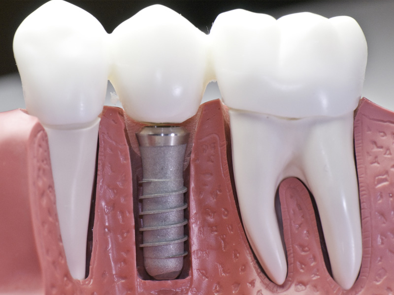 dental implants