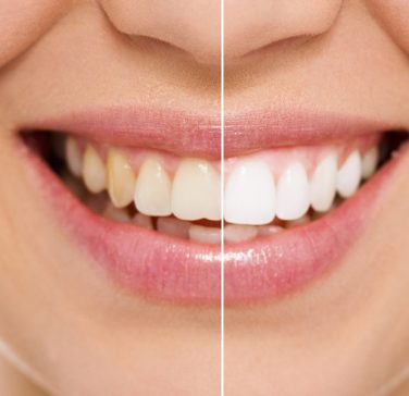 teeth-white
