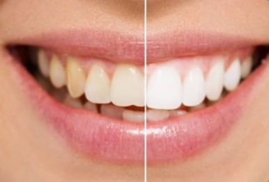 WHITENING img
