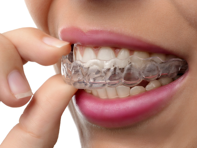 Invisalign Services 2
