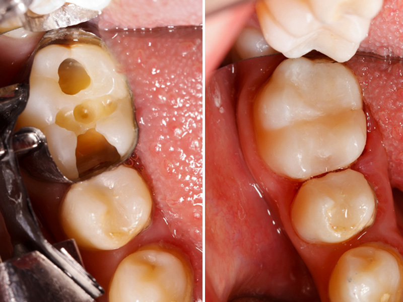 porcelain fillings